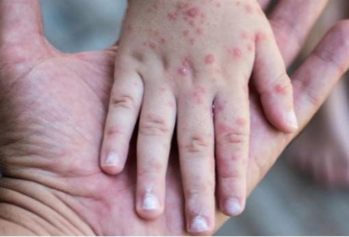 Ιλαρά: Διπλασιάστηκαν σε ένα χρόνο τα κρούσματα στην Ευρώπη