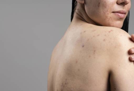 Ακμή στην πλάτη: 7 παράγοντες που την προκαλούν και ενδεχομένως αγνοείς