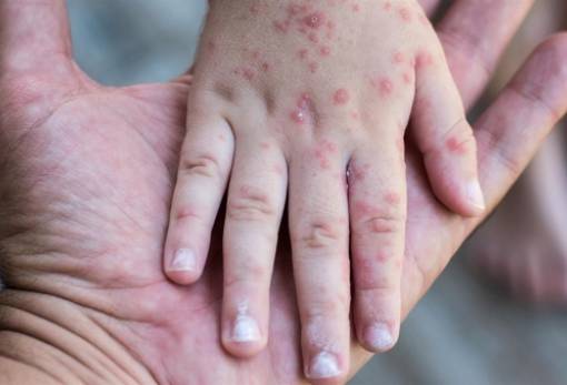 Ιλαρά: Σε ποιες χώρες καταγράφεται έξαρση