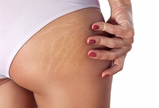 3 φυσικοί τρόποι για να εξαφανίσεις τα σημάδια στα πόδια