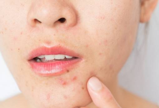 5 tips για να περιορίσεις τα σπυράκια το καλοκαίρι