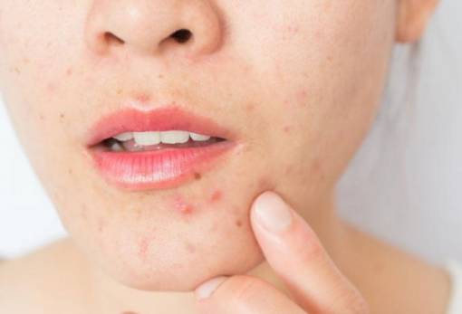 3 βασικά πράγματα που δεν ξέρεις για τα σπυράκια σου