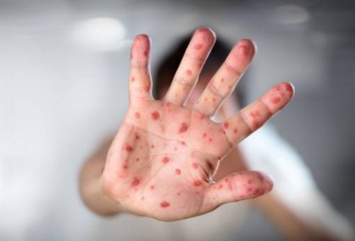 Προειδοποίηση Που για επικείμενη έξαρση κρουσμάτων Ιλαράς