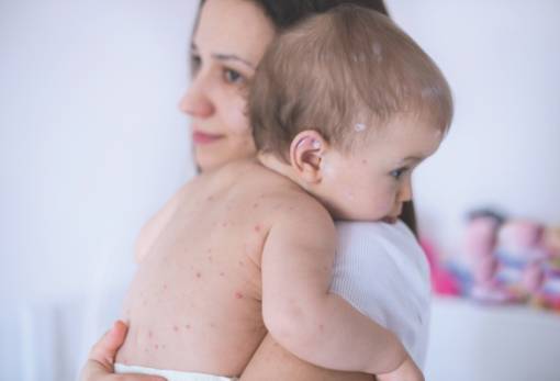 Ιλαρά: Έξαρση σε 37 χώρες το 2022 - Η μία στην Ευρώπη