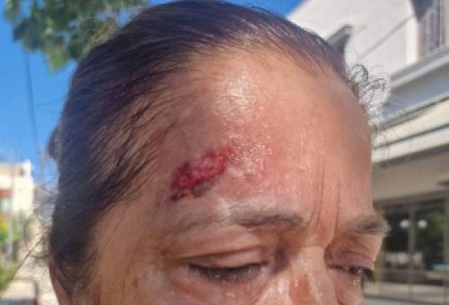 Επίπονος τραυματισμός γυναίκας στο Open Mall Σπάρτης