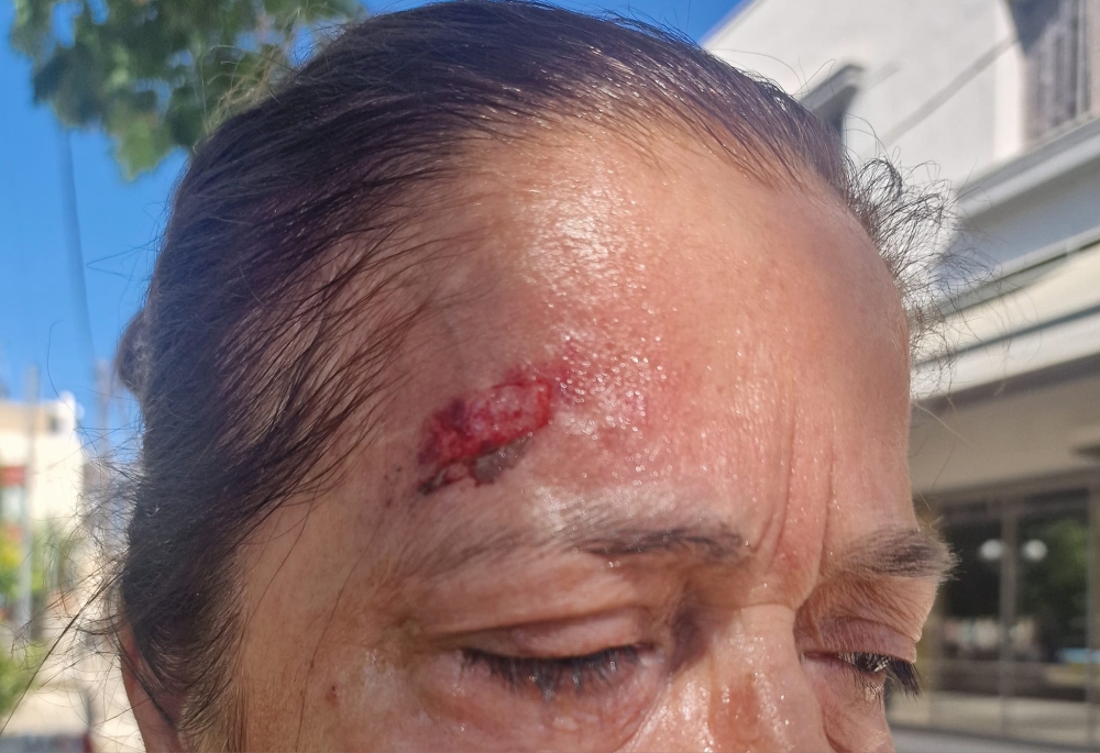 &Epsilon;&pi;ί&pi;&omicron;&nu;&omicron;&sigmaf; &tau;&rho;&alpha;&upsilon;&mu;&alpha;&tau;&iota;&sigma;&mu;ό&sigmaf; &gamma;&upsilon;&nu;&alpha;ί&kappa;&alpha;&sigmaf; &sigma;&tau;&omicron; Open Mall &Sigma;&pi;ά&rho;&tau;&eta;&sigmaf;